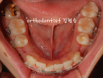 강남 돌출 관련 이미지 24