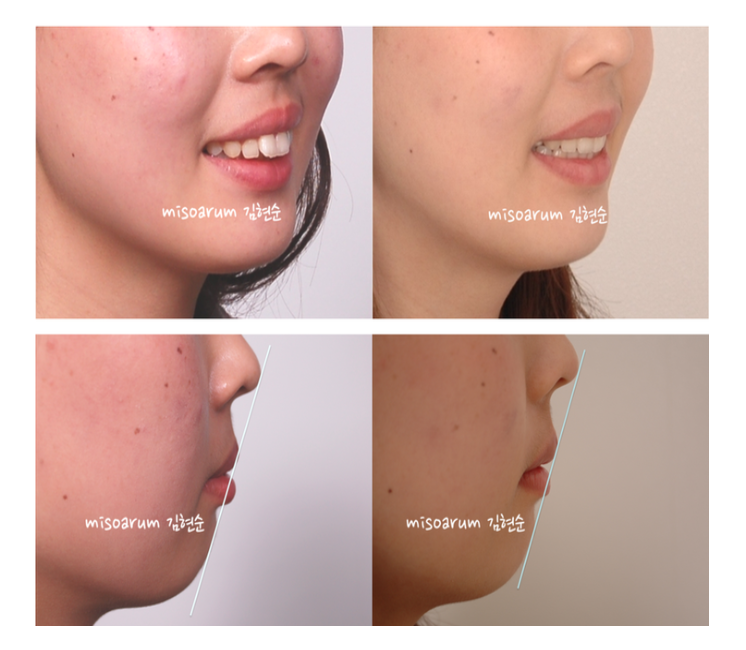 강남 돌출입 관련 이미지 8