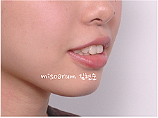 강남 돌출입 교정 관련 이미지 17