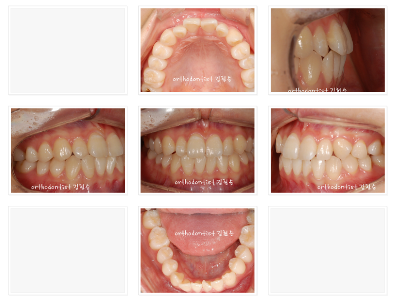 치아의 배열을 개선, 발치하지 않고 교정하기 관련 이미지 4