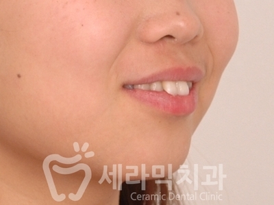 돌출입치아교정 전후사진(발치교정, 토끼이빨 인상변화) 관련 이미지 4