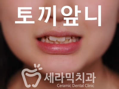토끼이빨 돌출입 치아교정 전후 표정변화! 관련 이미지 1