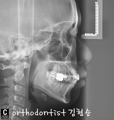 강남 덧니, 돌출 관련 이미지 10