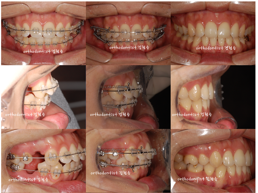 돌출입발치 교정증례 관련 이미지 4