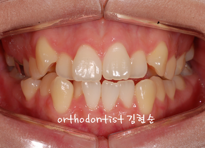 치열 교정(치열 불규칙) 관련 이미지 15