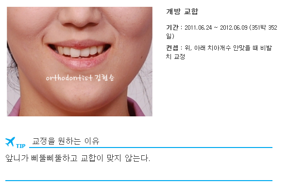 개방교합 비발치 세라믹교정 관련 이미지 4