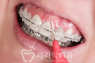 치아교정을 하면 입 냄새가 많이 나요? 관련 이미지 7