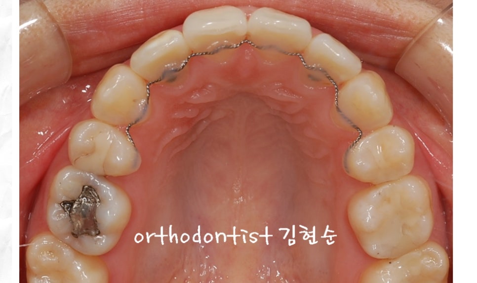 돌출입교정 / 기간 / 비용 관련 이미지 7
