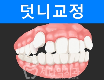 덧니와 돌출입을 한번에! 치아교정 전후사진 관련 이미지 1