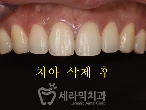 무삭제 라미네이트라면서? 대체 얼마나 삭제하는거죠? 관련 이미지 4