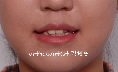 치열 교정(치열 불규칙) 관련 이미지 4