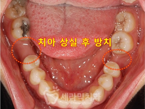 돌출입교정만 했을 뿐인데, 성형한 것처럼 달라진 인상! 관련 이미지 7