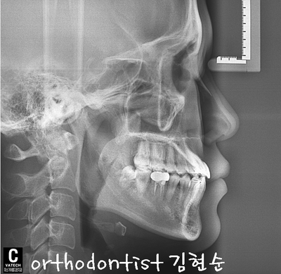 반대 교합 관련 이미지 35