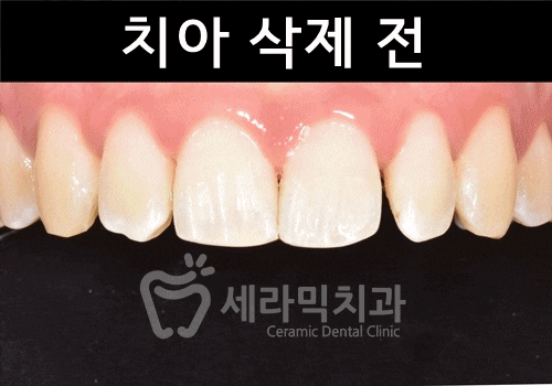 무삭제라미네이트 , 세라네이트가 궁금하다면? 관련 이미지 10