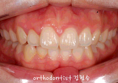 강남 돌출 관련 이미지 7