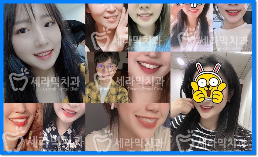 상실된 치아가 있어도, 금니가 있어도 치아교정전후는 계속된다! 관련 이미지 10