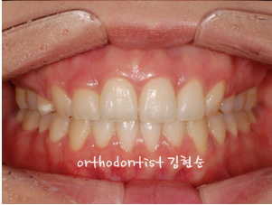 강남 돌출입 교정 관련 이미지 14