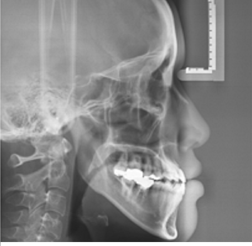 주걱턱수술 안하고 양악수술 안하고 관련 이미지 4