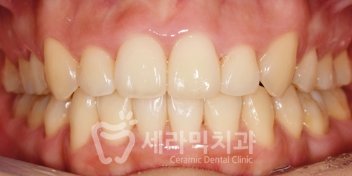 치아교정만으로 세마리 토끼를 한번에! 돌출입, 무턱, 치열불규칙 치아교정전후 관련 이미지 10