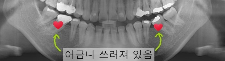 세라믹교정 은 세라믹치과 돌출입교정 관련 이미지 2
