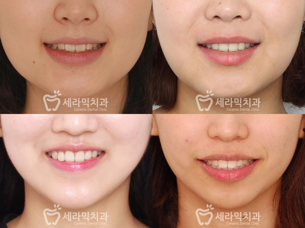 토끼이빨 교정 잘하는곳 강남 세라믹치과! 관련 이미지 6