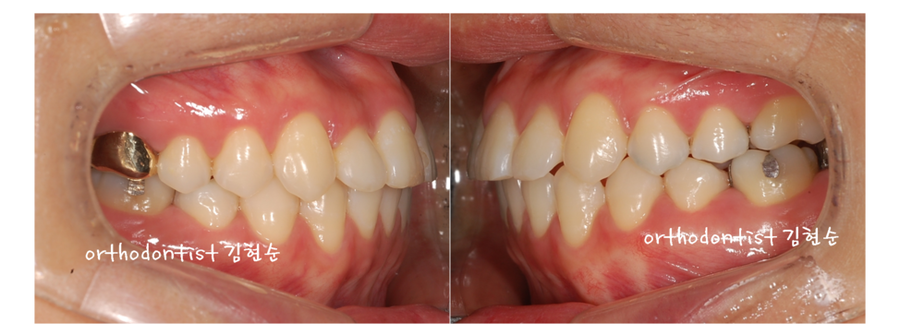 안면비대칭 교정, 치아교정만으로 간단히 해결하기 관련 이미지 15