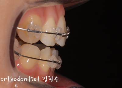 개방 교합 관련 이미지 16