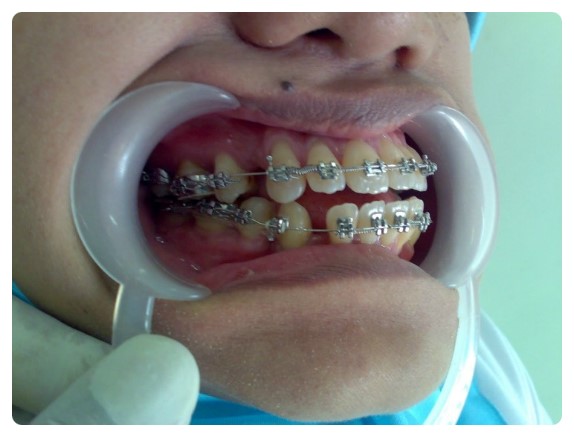 치아교정시 주의사항 관련 이미지 1
