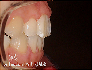강남 돌출입 교정 관련 이미지 17