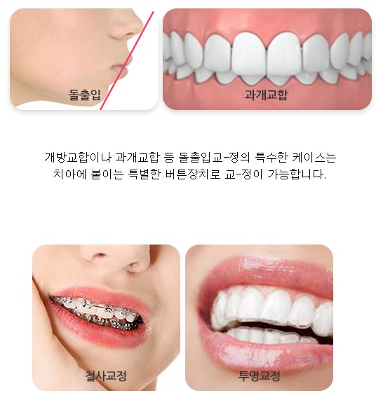 투명교정후기 세라믹치과 ~ 관련 이미지 7