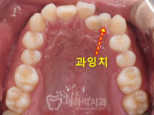 A Case of Overretained Teeth and Deep Bite Orthodontics That Helped the Patient Smile Confidently Before and After image 9