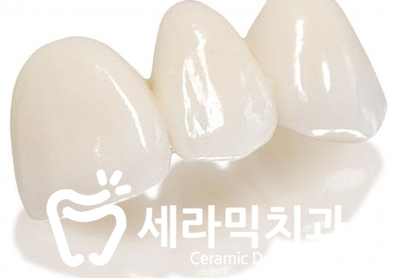 벌어진 앞니, 치아 사이 공간 교정 잘하는 세라믹치과 관련 이미지 5