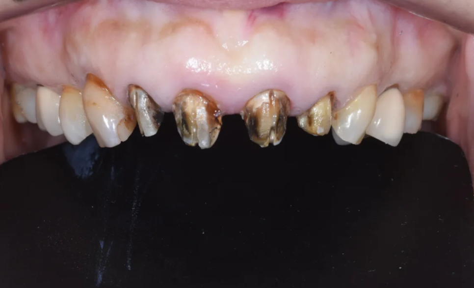 일본에서 거절당했던 앞니 심미보철 크라운 관련 이미지 9