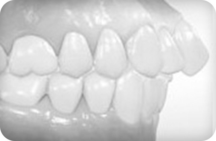 강남치아교정 브라켓비교분석 관련 이미지 11