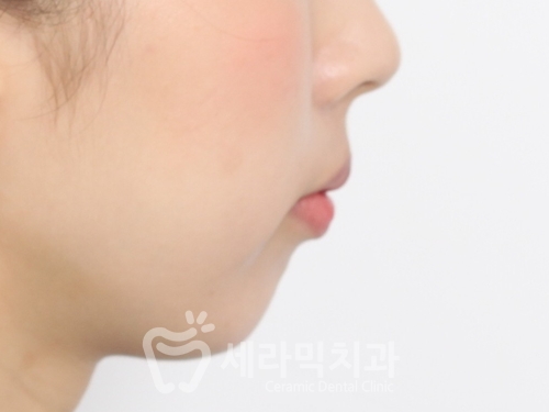 앞니 돌출, 개방교합으로 치아교정을 시작했는데, 작았던 아래턱이 커졌어요! 관련 이미지 11