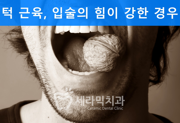 옥니 없이 치아교정잘하는곳, 강남 세라믹치과 관련 이미지 2