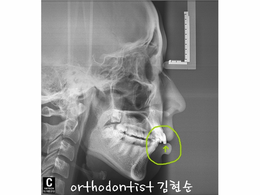 세라믹교정 세라믹치과-돌출입발치교정 2 관련 이미지 3