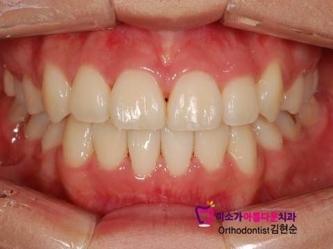 논현동교정잘하는치과에서 알려주는 교정과정! 고무줄 관련 이미지 4