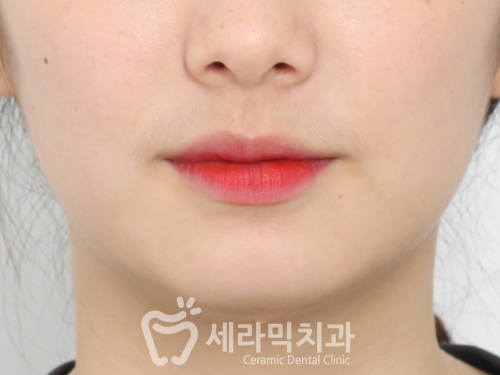 돌출입교정, 심미성과 치아 건강을 동시에 해결! 관련 이미지 20