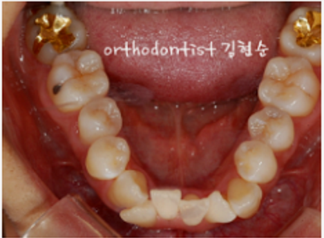 강남 덧니 관련 이미지 9