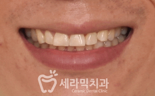 치아교정과 라미네이트는 선택이 아닌 상호 보완관계! 관련 이미지 10
