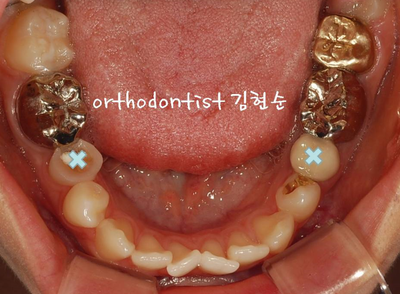 강남 돌출입 교정 관련 이미지 8