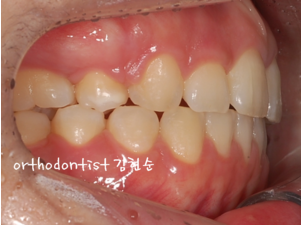 강남 돌출입 교정 관련 이미지 26