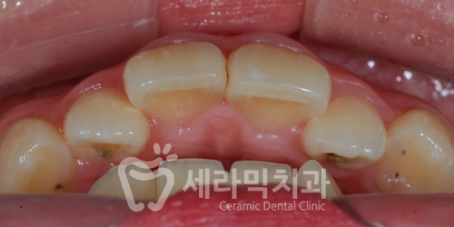 앞니 돌출, 개방교합으로 치아교정을 시작했는데, 작았던 아래턱이 커졌어요! 관련 이미지 8