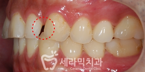 벌어진치아 투명교정 치아교정전후 관련 이미지 4