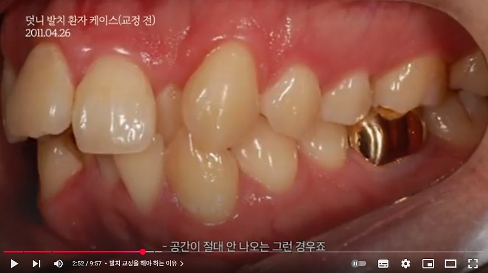 발치교정 vs 비발치교정, 어떤 선택을 해야 후회 없을까? 관련 이미지 2