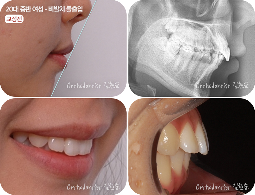 돌출입 비발치 치아교정 관련 이미지 5