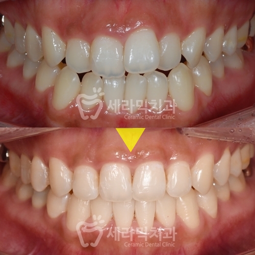 Open Bite Dental Clinic Orthodontic Before and After: Did a Long-Looking Jaw Become Shorter? image 8