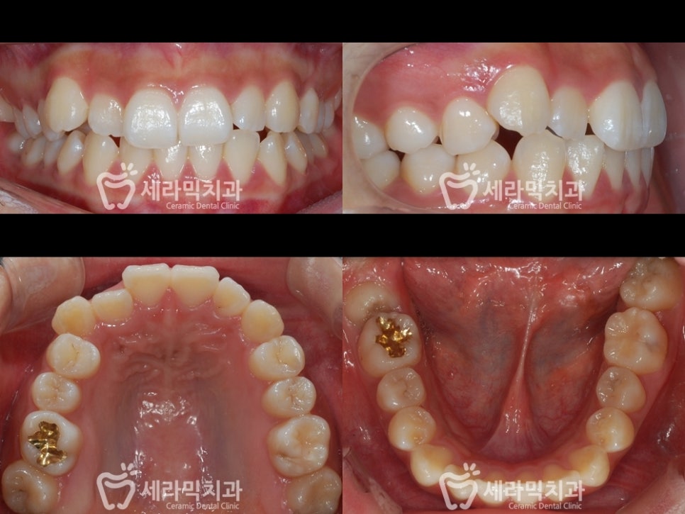 교정 전 어색한 웃음이 치아교정전후 함박웃음으로 변하게 된 사례 관련 이미지 4