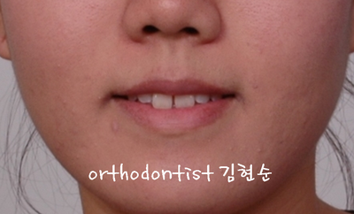 치열 교정 ( 벌어짐 ) 관련 이미지 4